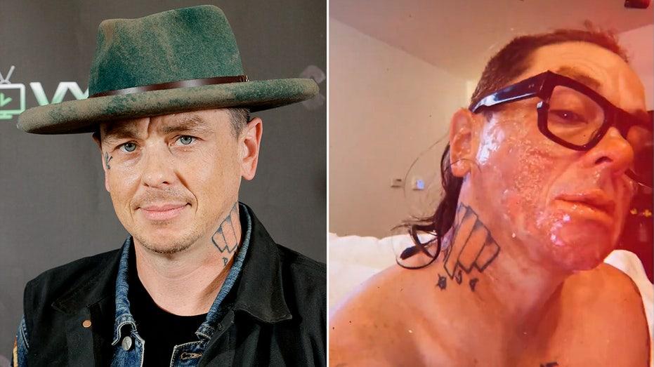 Sid Wilson Burned in Bonfire Explosion on Farm