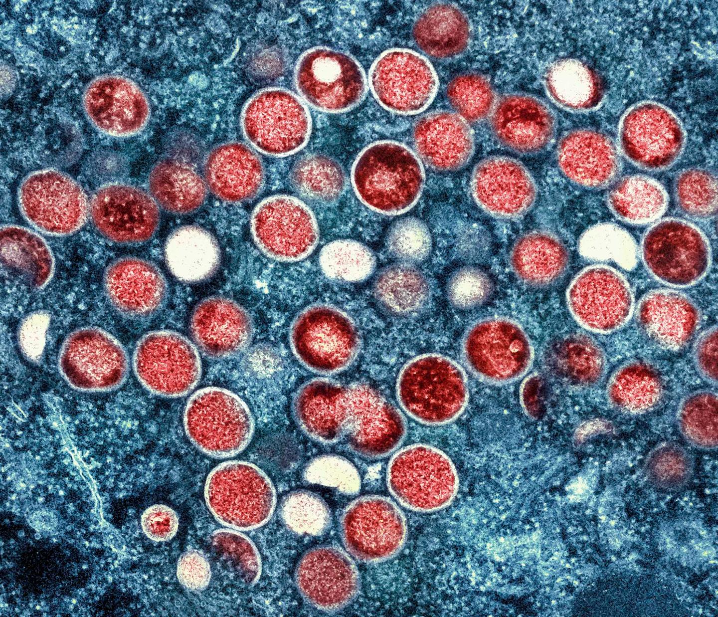 Mpox outbreak in Kenya